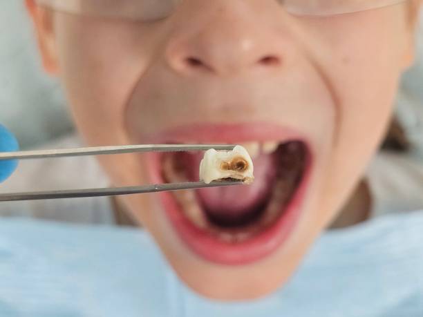 Best Broken or Cracked Tooth Emergency Dentist in Cole Camp, MO